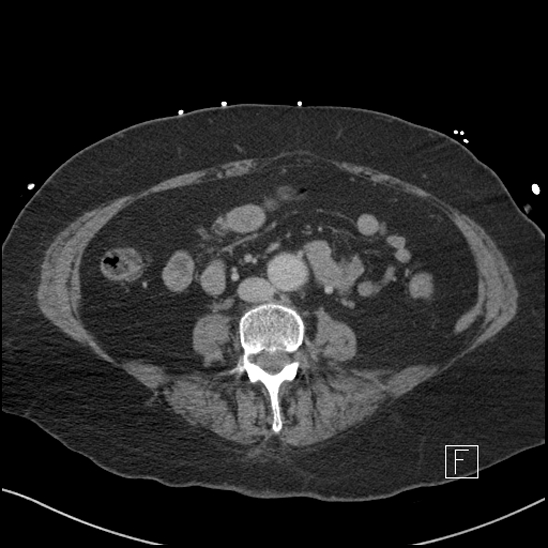 Aortic intramural hematoma with dissection and intramural blood pool (Radiopaedia 77373-89491 E 49).jpg