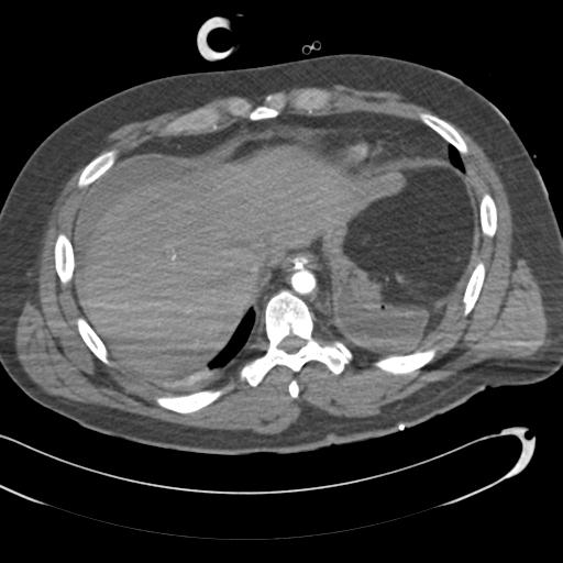 Aortic transection, diaphragmatic rupture and hemoperitoneum in a complex multitrauma patient (Radiopaedia 31701-32622 A 70).jpg