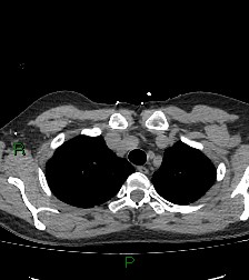 Aortic valve endocarditis (Radiopaedia 87209-103485 Axial non-contrast 22).jpg