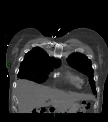 Aortic valve endocarditis (Radiopaedia 87209-103485 D 59).jpg