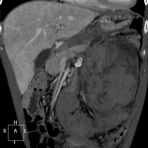 Aorto-left renal vein fistula (Radiopaedia 45534-49628 B 13).jpg