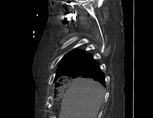 Aortoesophageal fistula with endovascular repair (Radiopaedia 73781-84592 Sagittal C+ CTPA 18).jpg