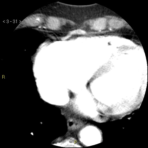 File:Aortoiliac occlusive disease (Radiopaedia 16828-16548 A 31).jpg