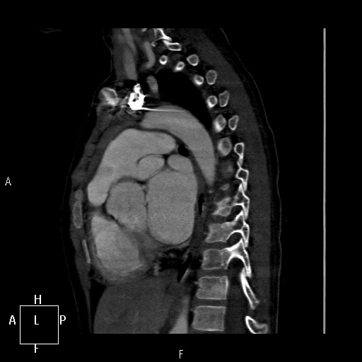 File:Aortopulmonary septal defect (Radiopaedia 41990-45013 Sagittal C+ CTPA 23).jpg