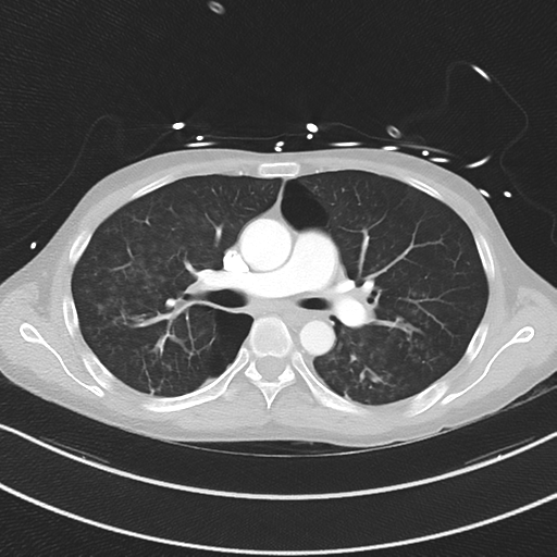 Apical bullous disease in a heavy smoker (Radiopaedia 33067-34092 Axial lung window 28).png