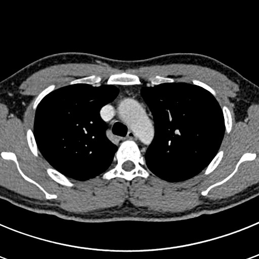 Apical lung mass mimic - neurogenic tumor (Radiopaedia 59918-67521 A 25).jpg