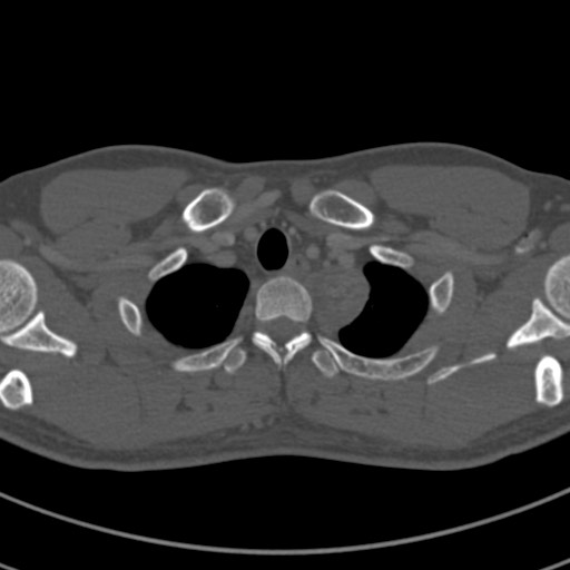 Apical lung mass mimic - neurogenic tumor (Radiopaedia 59918-67521 Axial bone window 9).jpg