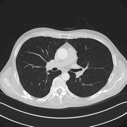 Apical pleural calcification (Radiopaedia 46141-50499 Axial lung window 31).png