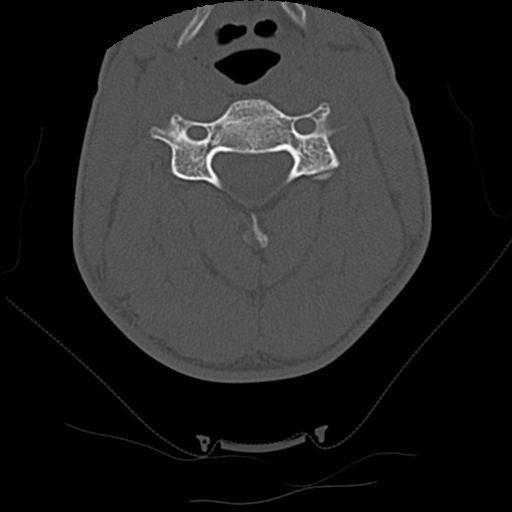 File:Apical pneumothorax on cervical spine CT (Radiopaedia 45343-49368 Axial bone window 41).jpg