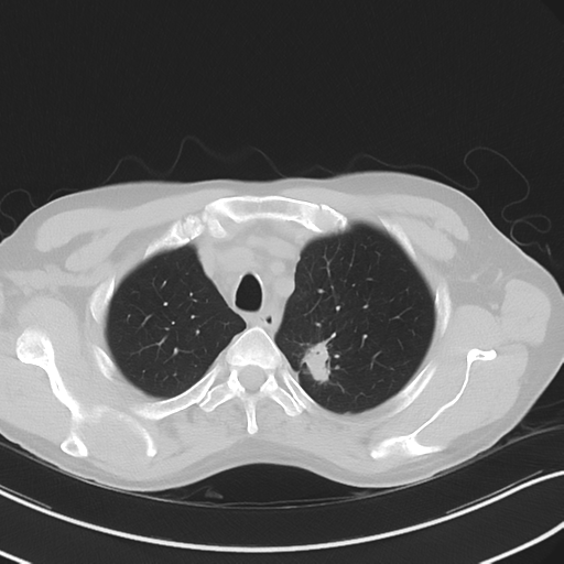Apical pulmonary metastasis (Radiopaedia 46338-50754 Axial non-contrast 15).png