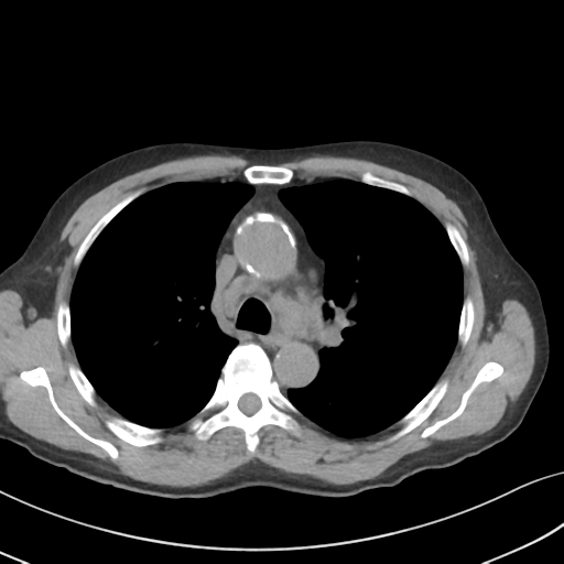 Apical pulmonary metastasis (Radiopaedia 46338-50754 B 25).png