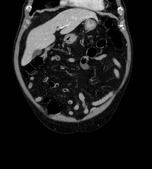 Appendiceal adenocarcinoma complicated by retroperitoneal abscess (Radiopaedia 58007-65039 A 21).jpg