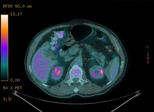 Appendiceal adenocarcinoma complicated by retroperitoneal abscess (Radiopaedia 58007-65041 Axial PET-CT 114).jpg