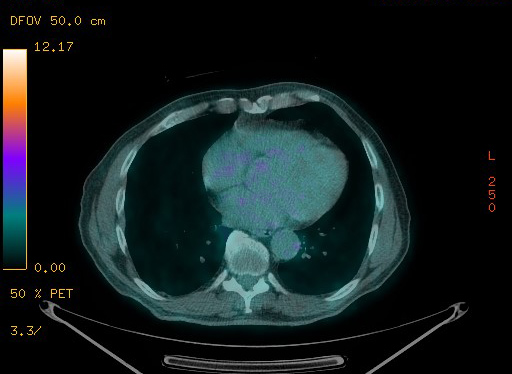 Appendiceal adenocarcinoma complicated by retroperitoneal abscess (Radiopaedia 58007-65041 Axial PET-CT 82).jpg