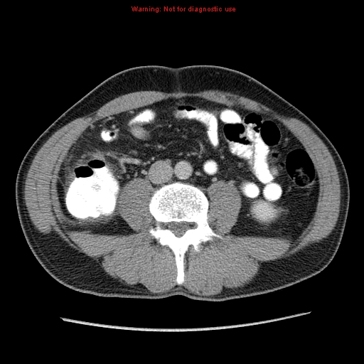 Appendicitis and renal cell carcinoma (Radiopaedia 17063-16760 A 34).jpg