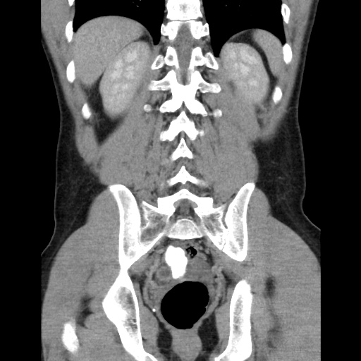 Appendicitis complicated by post-operative collection (Radiopaedia 35595-37113 B 41).jpg
