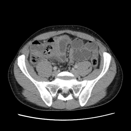 File:Appendicitis complicated by post-operative collection (Radiopaedia 35595-37114 A 62).jpg