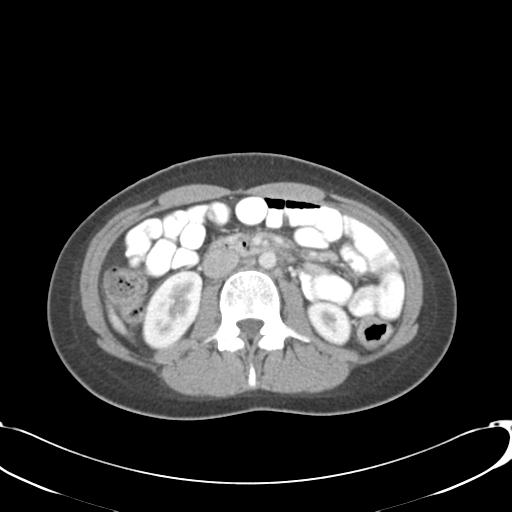 File:Appendicitis with minimal stranding but appendicolith (Radiopaedia 29035-29397 A 39).jpg