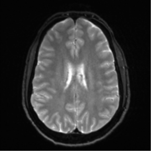 Arachnoid cyst - cerebellopontine angle (Radiopaedia 59689-67083 Axial DWI 23).png
