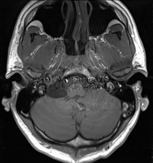File:Arachnoid cyst - cerebellopontine angle (Radiopaedia 59689-67083 Axial T1 8).png