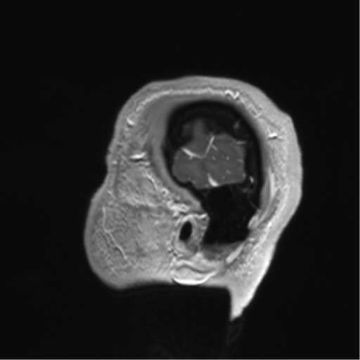 Arachnoid cyst with subdural hematoma (Radiopaedia 85892-101743 Sagittal T1 C+ 85).png