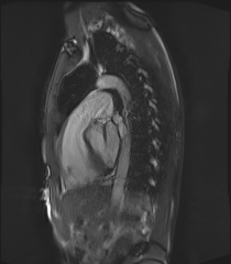 File:Arrhythmogenic right ventricular cardiomyopathy (Radiopaedia 57972-64966 Cine RVOT SSFP 7).jpg