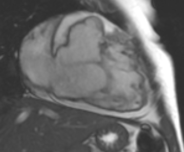 Arrhythmogenic right ventricular cardiomyopathy (Radiopaedia 69431-79307 2ch cine 42).jpg