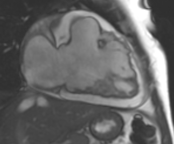 Arrhythmogenic right ventricular cardiomyopathy (Radiopaedia 69431-79307 2ch cine 71).jpg