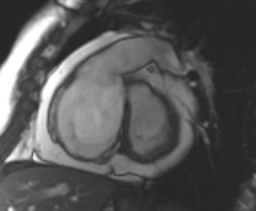 Arrhythmogenic right ventricular cardiomyopathy (Radiopaedia 69431-79307 Short axis cine 197).jpg