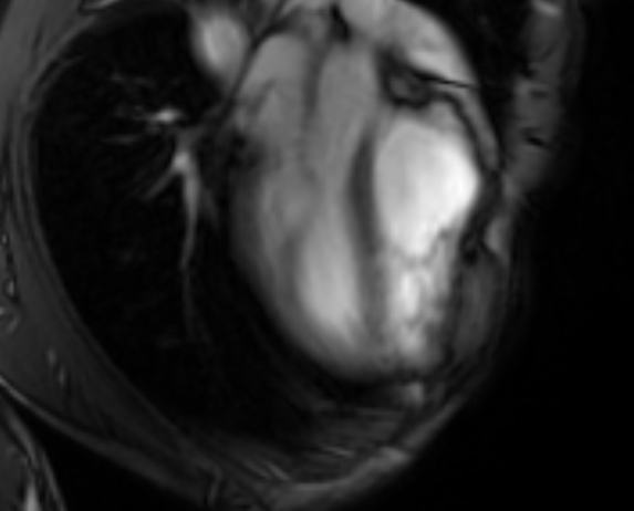 Arrhythmogenic right ventricular cardiomyopathy (Radiopaedia 69564-79464 4ch cine 29).jpg