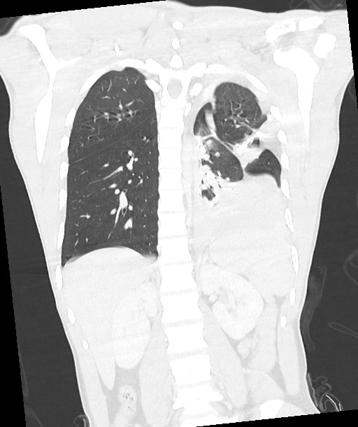 Arrow injury to the chest (Radiopaedia 85367-100975 Coronal lung window 93).jpg