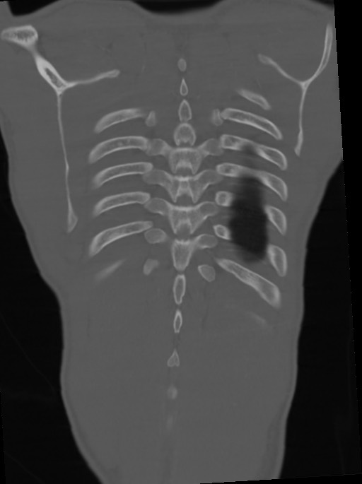 Arrow injury to the neck (Radiopaedia 75225-86323 Coronal bone window 103).jpg
