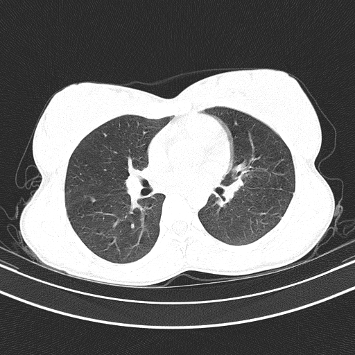 File:Arteria lusoria (Radiopaedia 88528-105192 Axial lung window 33).jpg