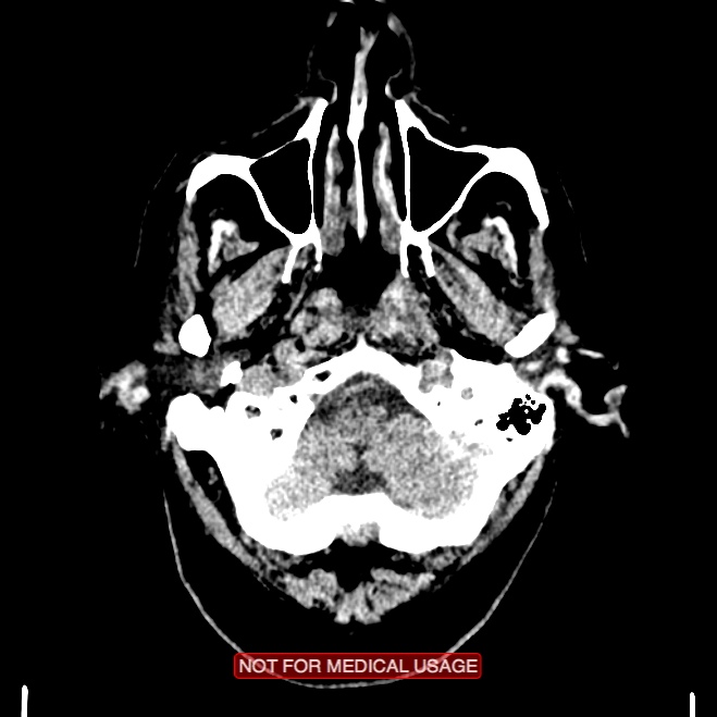 Artery of Percheron infarction (Radiopaedia 28679-28967 Axial non-contrast 12).jpg