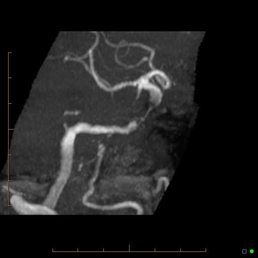 File:Artifactual basilar artery stenosis due to metallic stent (Radiopaedia 31206-31922 3D MIP 7).jpg
