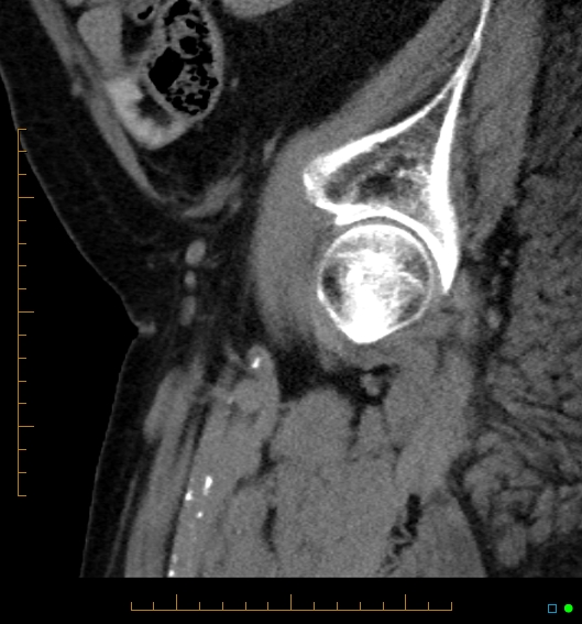 File:Artificial urethral sphincter (Radiopaedia 46937-51464 Sagittal C+ delayed 1).jpg