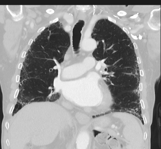 File:Asbestosis (Radiopaedia 56192-62864 Coronal lung window 26).png