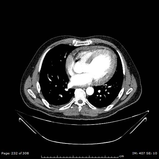 Ascending aortic aneurysm (Radiopaedia 50086-55404 A 60).jpg
