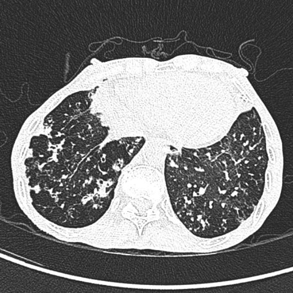Aspergilloma- with Monod sign (Radiopaedia 44737-48532 Axial lung window 230).jpg
