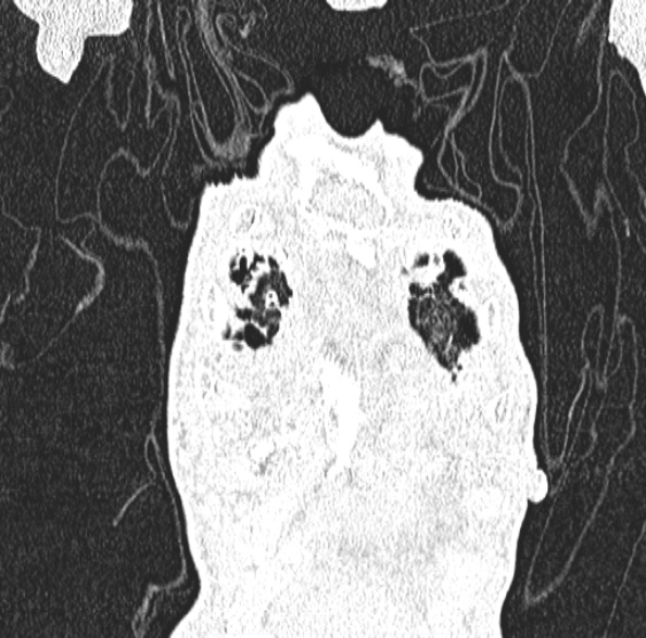 File:Aspergilloma- with Monod sign (Radiopaedia 44737-48532 Coronal lung window 128).jpg