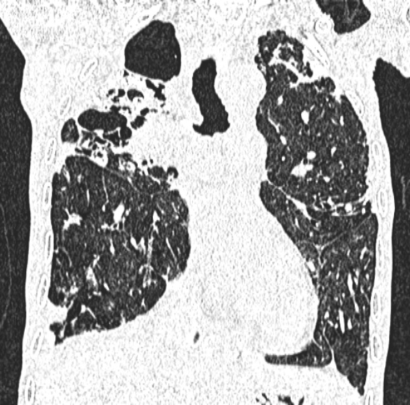 Aspergilloma- with Monod sign (Radiopaedia 44737-48532 Coronal lung window 234).jpg