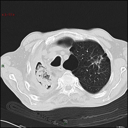 File:Aspergilloma (Radiopaedia 14842-14787 Axial lung window 11).jpg
