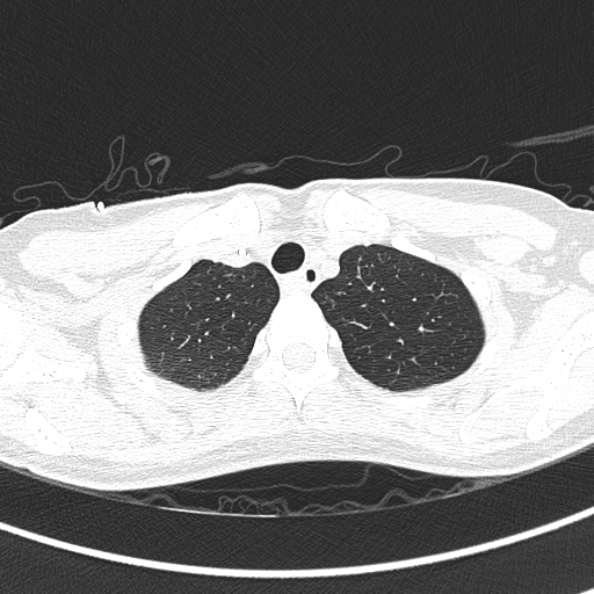 File:Aspergilloma (Radiopaedia 26223-26347 Axial lung window 11).jpg