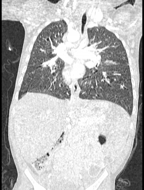 Asplenia syndrome (Radiopaedia 73083-83792 Coronal lung window 76).jpg