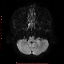 File:Astroblastoma (Radiopaedia 74287-85162 Axial DWI 12).jpg