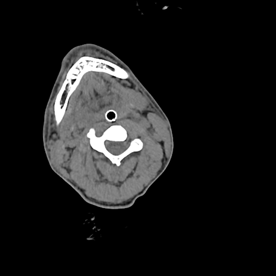 File:Atlanto-occipital dissociation (Traynelis type 1), C2 teardrop fracture, C6-7 facet joint dislocation (Radiopaedia 87655-104061 Axial non-contrast 35).jpg