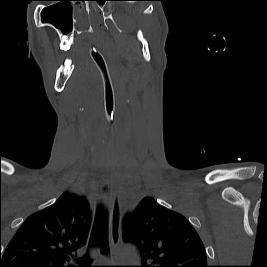 File:Atlanto-occipital dissociation (Traynelis type 1), C2 teardrop fracture, C6-7 facet joint dislocation (Radiopaedia 87655-104061 Coronal bone window 27).jpg