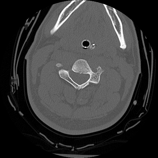 Atlanto-occipital dissociation injury (Radiopaedia 29274-29698 Axial bone window 32).png