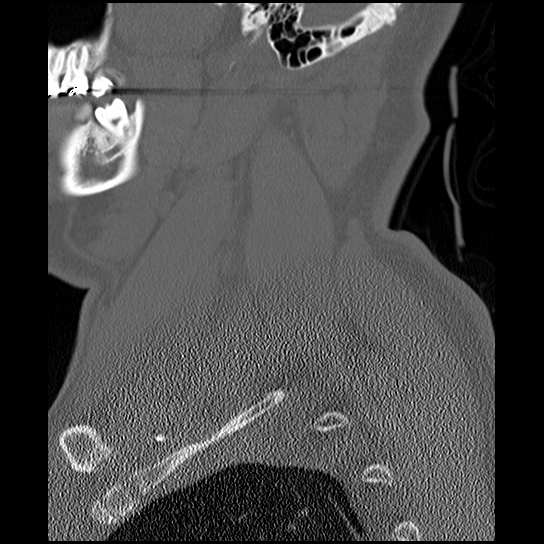 Atlanto-occipital dissociation injury (Radiopaedia 29274-29698 Sagittal bone window 7).png