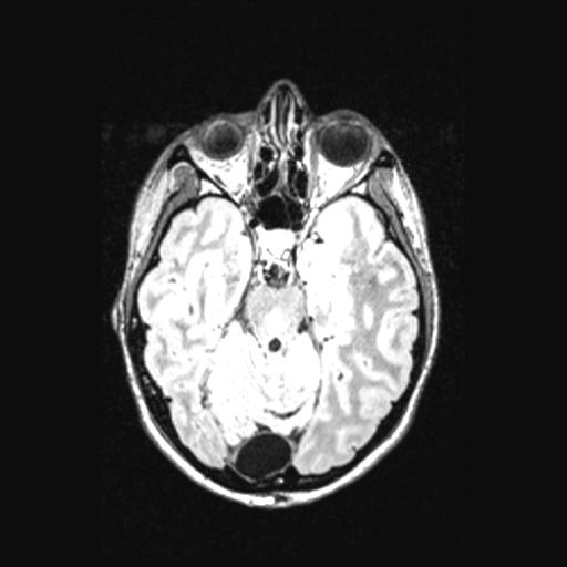 Atretic encephalocoele with inferior vermis hypoplasia (Radiopaedia 30443-31108 Axial 59).jpg